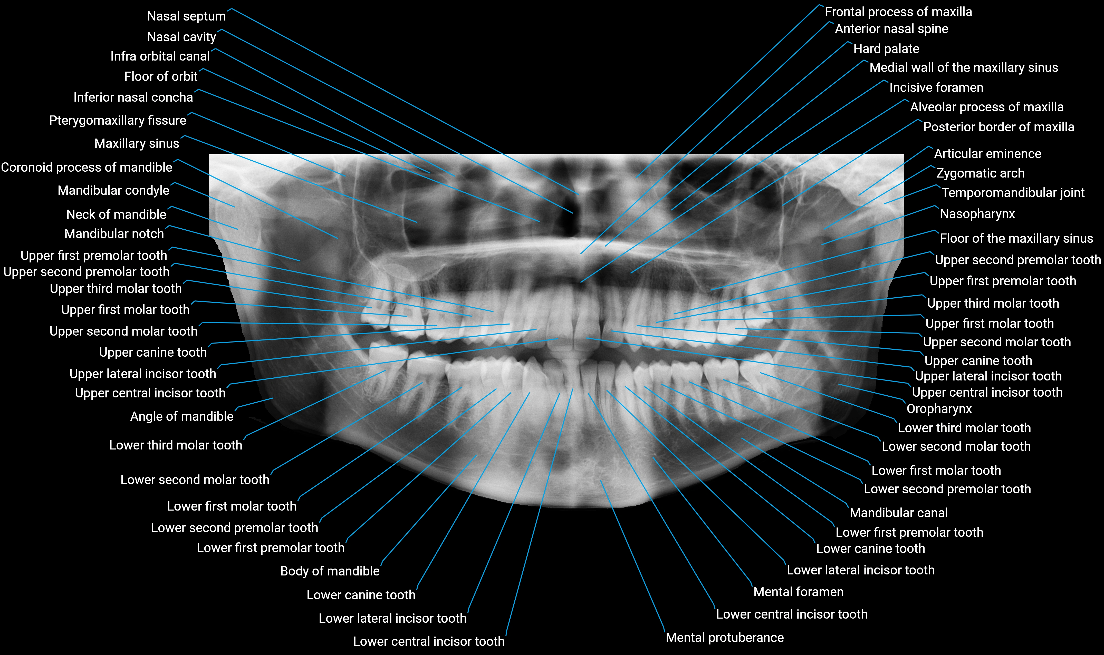 Orthopantomogram (OPG) X Ray anatomy labelled image 1.webp